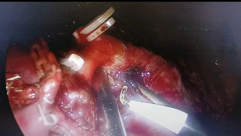 المؤسسة الاستشفائية لوهران:  أول عملية لاستئصال قطاع رئوي بتقنية VATS في الجزائر