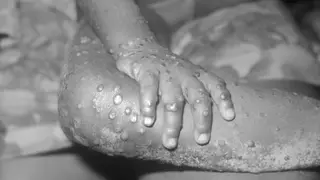 منظمة الصحة العالمية تحذر من احتمال انتقال عدوى جدري القردة بشكل أكبر خلال  فصل الصيف